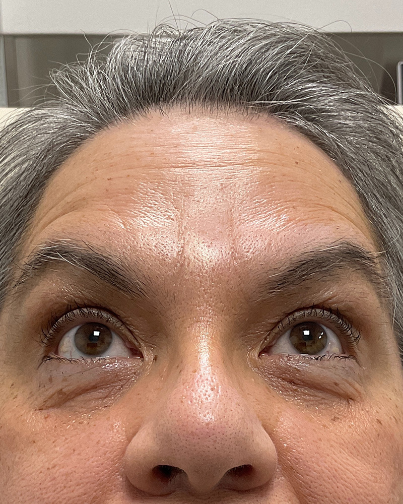 BOTOX Before & After Gallery - Patient 175045794 - Image 2