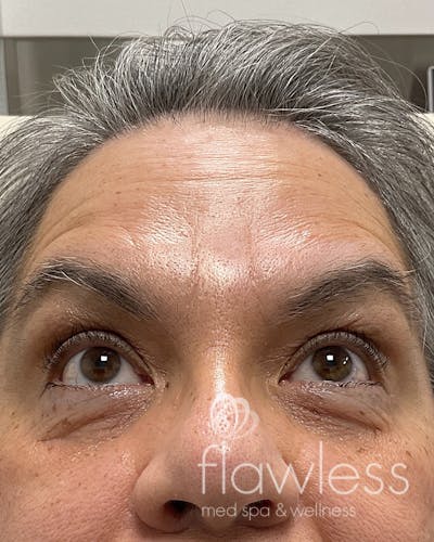 BOTOX Before & After Gallery - Patient 175045794 - Image 2