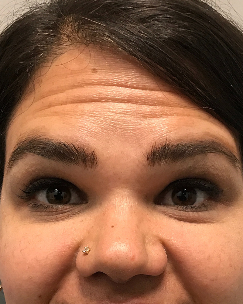 BOTOX Before & After Gallery - Patient 175045795 - Image 1