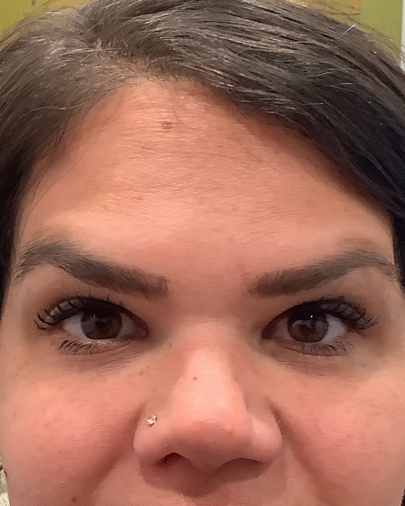 BOTOX Before & After Gallery - Patient 175045795 - Image 2