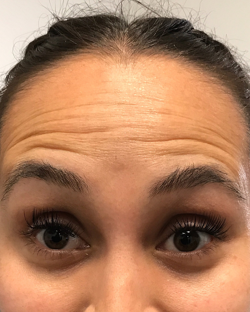 BOTOX Before & After Gallery - Patient 175045796 - Image 1