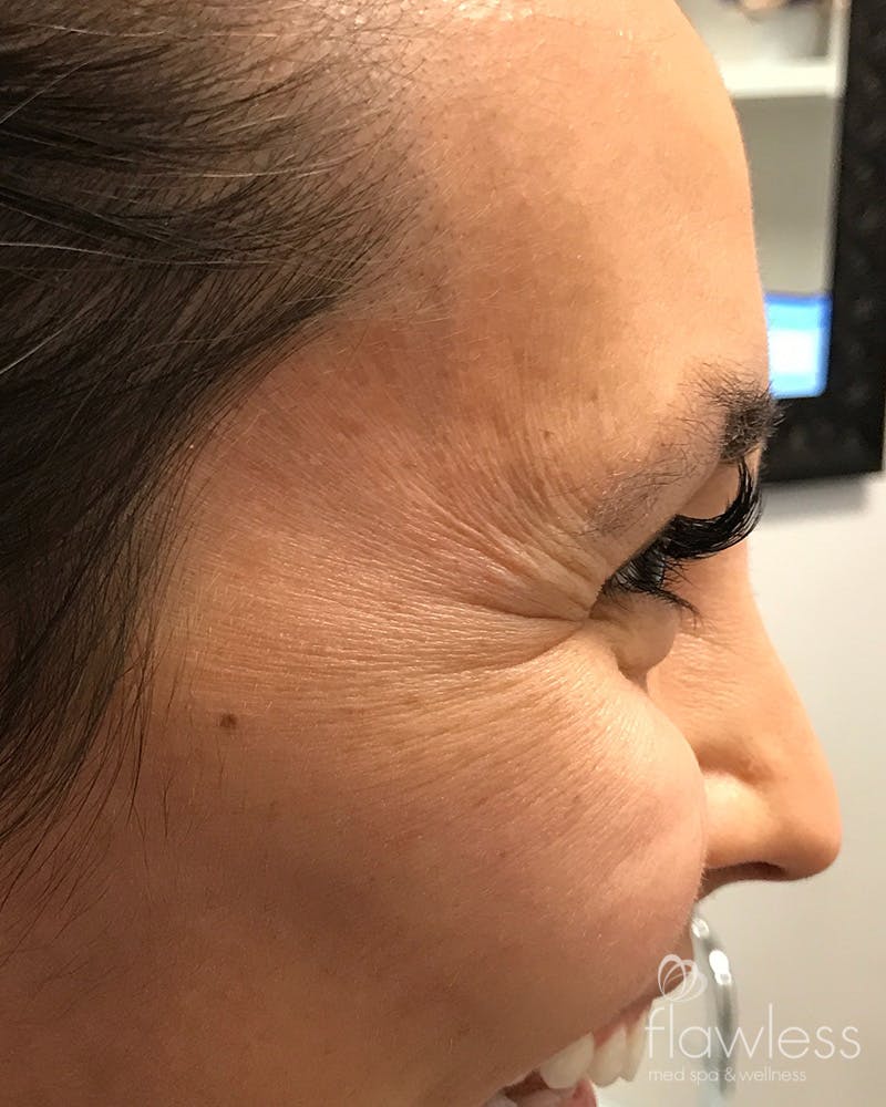 BOTOX Before & After Gallery - Patient 175045796 - Image 3