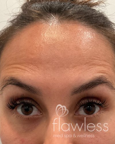 BOTOX Before & After Gallery - Patient 175045796 - Image 2