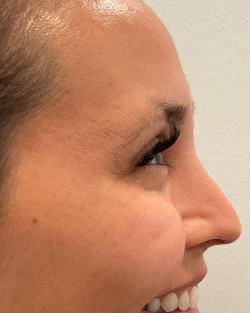 BOTOX Before & After Gallery - Patient 175045796 - Image 4
