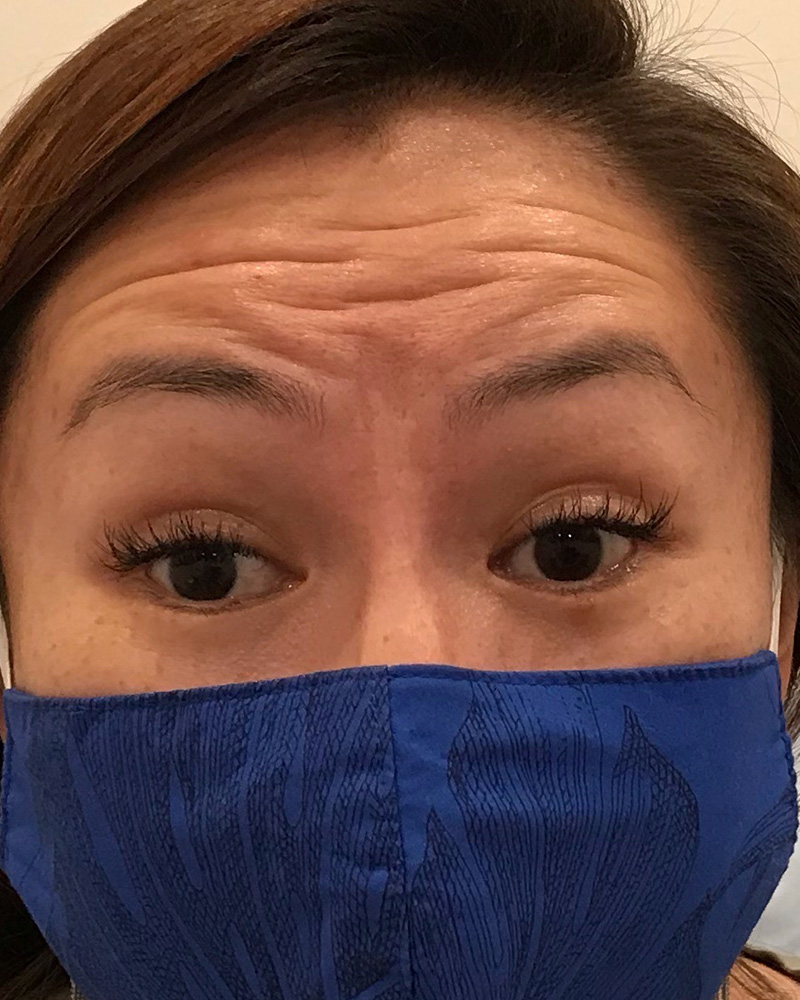 BOTOX Before & After Gallery - Patient 175045797 - Image 1