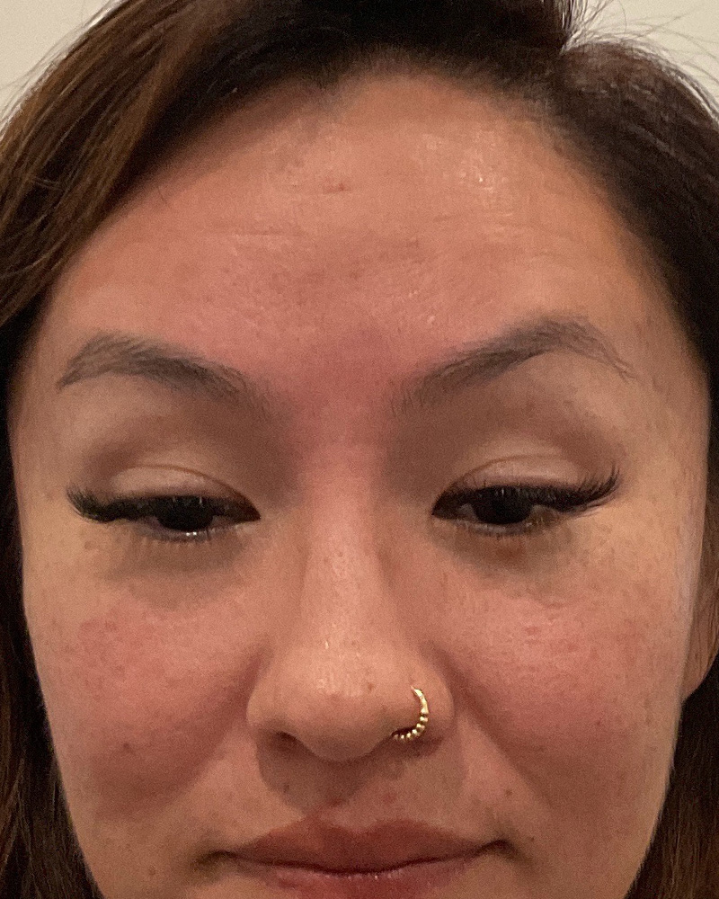 BOTOX Before & After Gallery - Patient 175045797 - Image 2