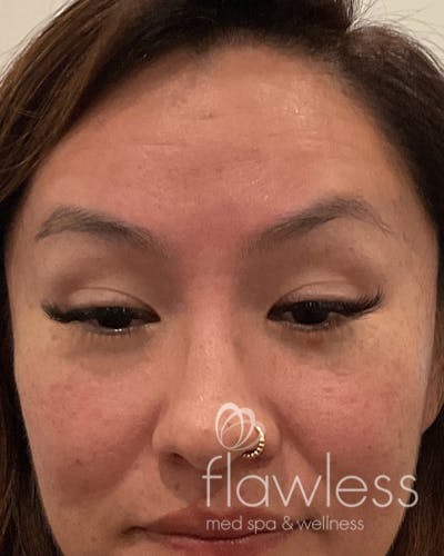 BOTOX Before & After Gallery - Patient 175045797 - Image 2