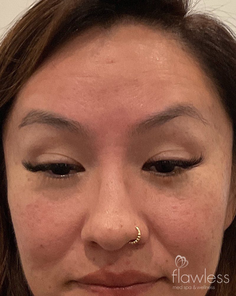 BOTOX Before & After Gallery - Patient 175045797 - Image 2