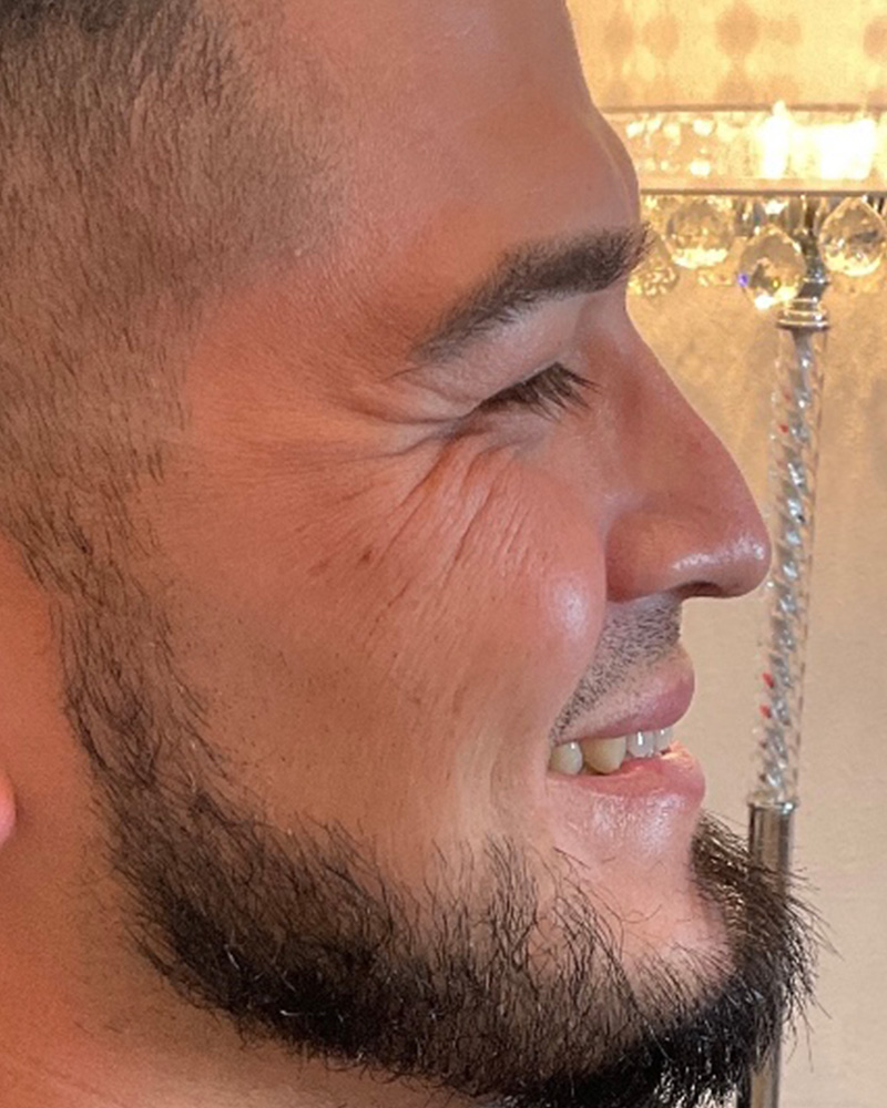 BOTOX Before & After Gallery - Patient 175045798 - Image 1