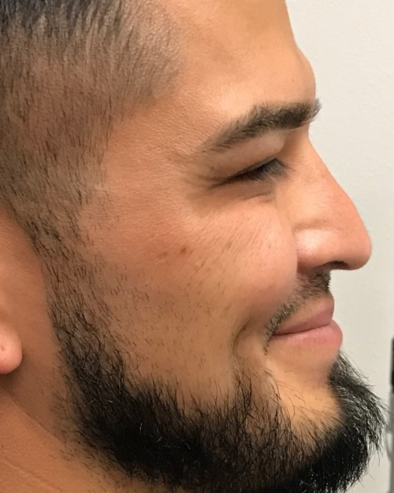 BOTOX Before & After Gallery - Patient 175045798 - Image 2