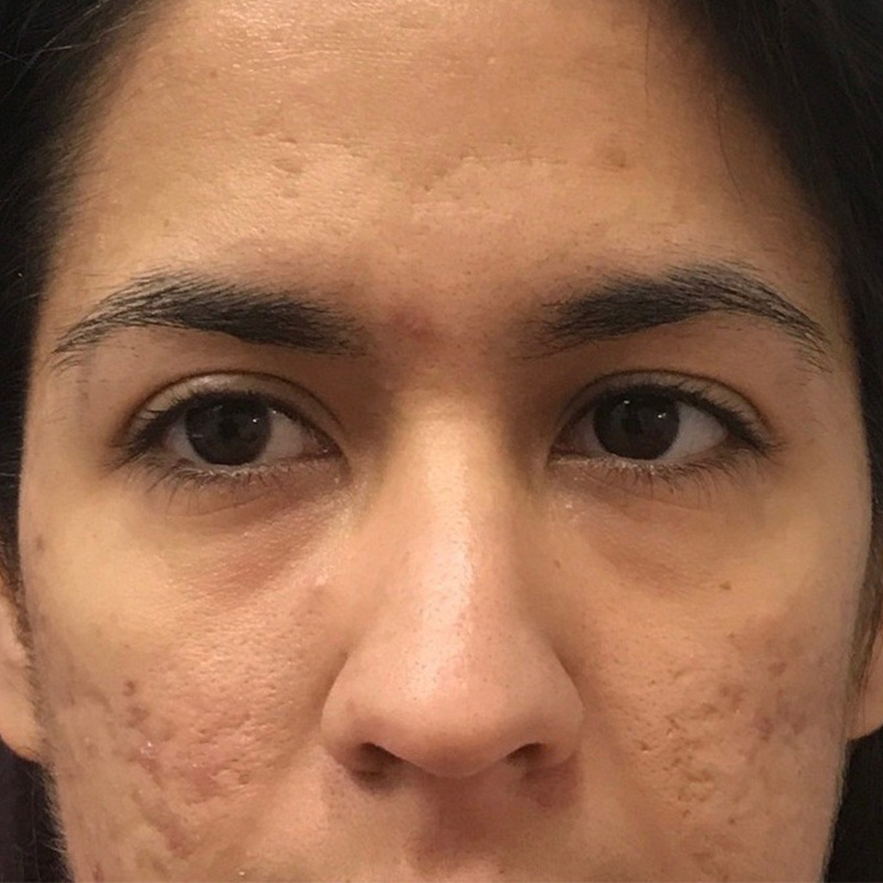 Tear Trough Filler Before & After Gallery - Patient 175530415 - Image 1