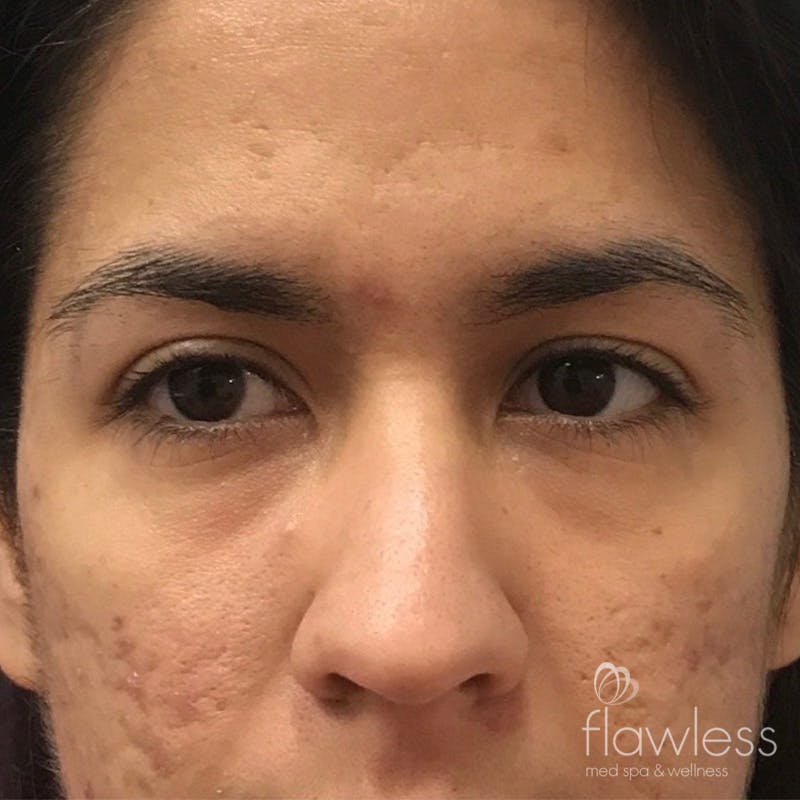 Tear Trough Filler Before & After Gallery - Patient 175530415 - Image 1