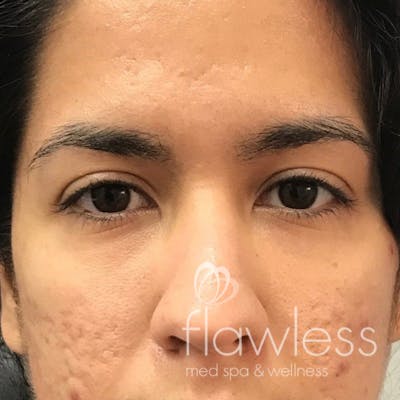 Tear Trough Filler Before & After Gallery - Patient 175530415 - Image 2