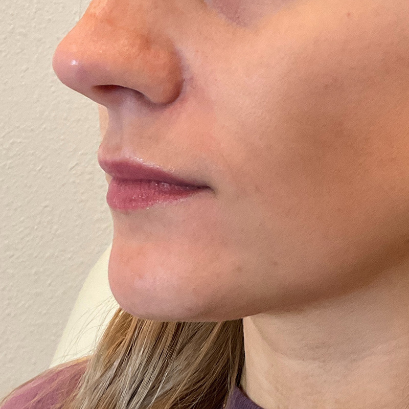 Lip Filler Before & After Gallery - Patient 58202345 - Image 3