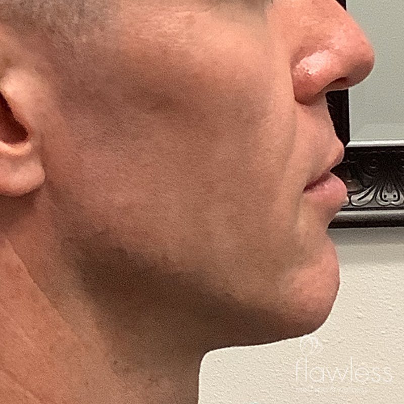 Jawline & Chin Filler Before & After Gallery - Patient 175530391 - Image 1