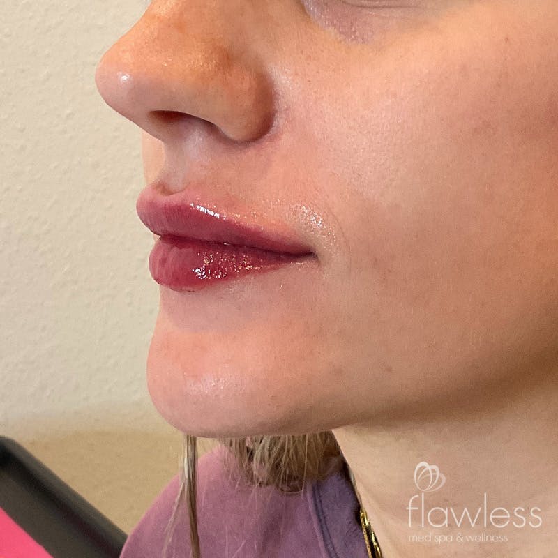 Lip Filler Before & After Gallery - Patient 58202345 - Image 4