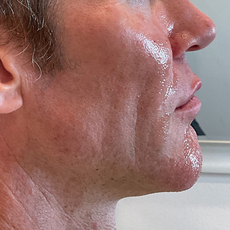 Jawline & Chin Filler Before & After Gallery - Patient 175530391 - Image 2