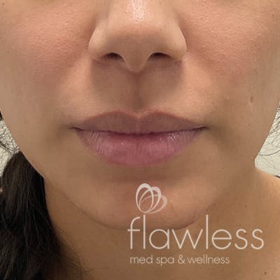 Lip Filler Before & After Gallery - Patient 175530400 - Image 1