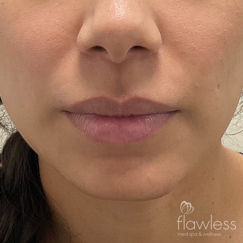 Lip Filler Before & After Gallery - Patient 175530400 - Image 1
