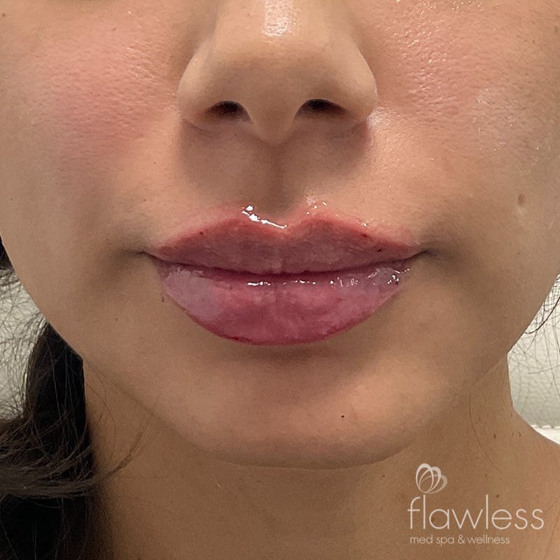 Lip Filler Before & After Gallery - Patient 175530400 - Image 2