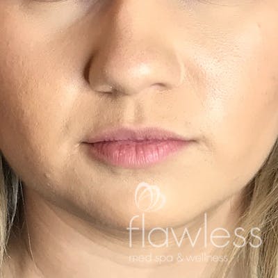 Lip Filler Before & After Gallery - Patient 175530399 - Image 1