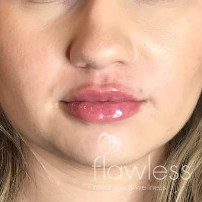 Lip Filler Before & After Gallery - Patient 175530399 - Image 2
