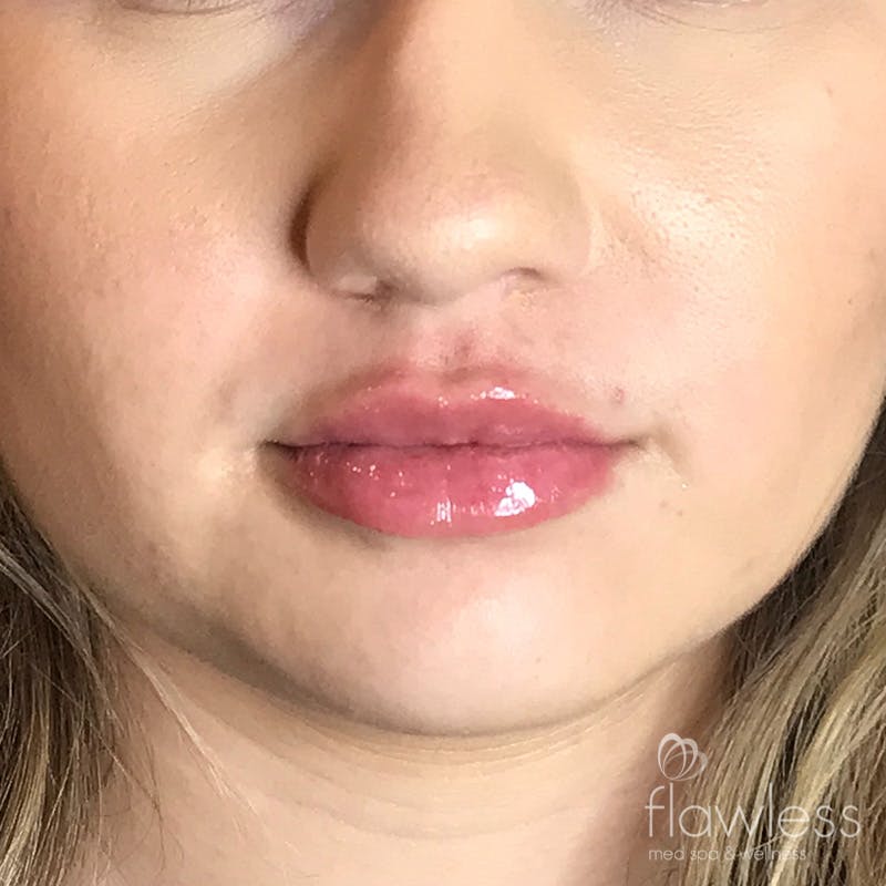 Lip Filler Before & After Gallery - Patient 175530399 - Image 2