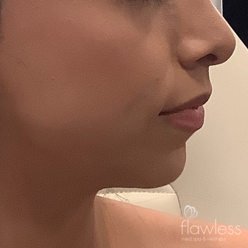 Jawline & Chin Filler Before & After Gallery - Patient 175530390 - Image 1