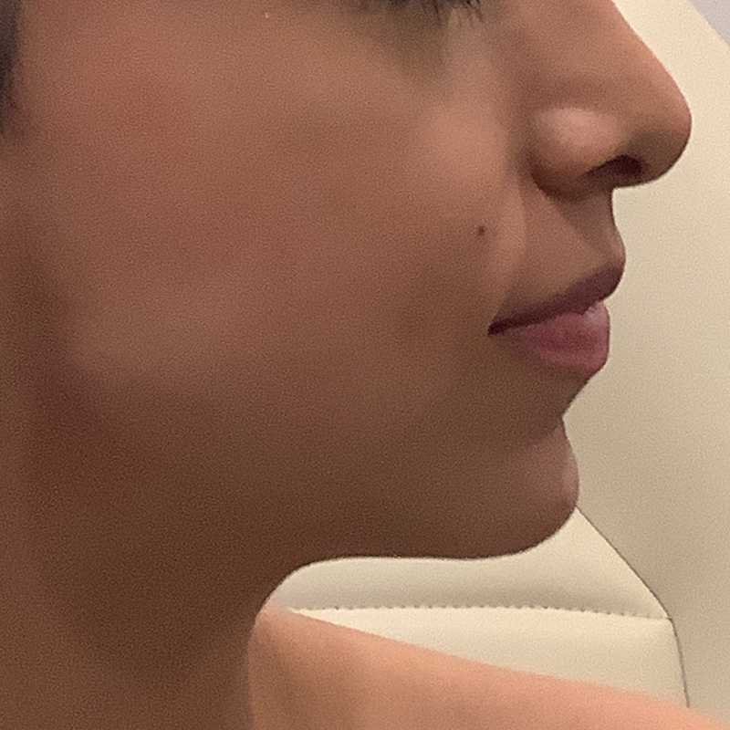 Jawline & Chin Filler Before & After Gallery - Patient 175530390 - Image 2