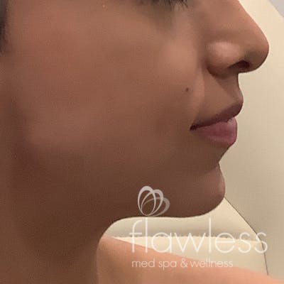 Jawline & Chin Filler Before & After Gallery - Patient 175530390 - Image 2