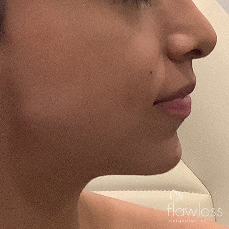 Jawline & Chin Filler Before & After Gallery - Patient 175530390 - Image 2
