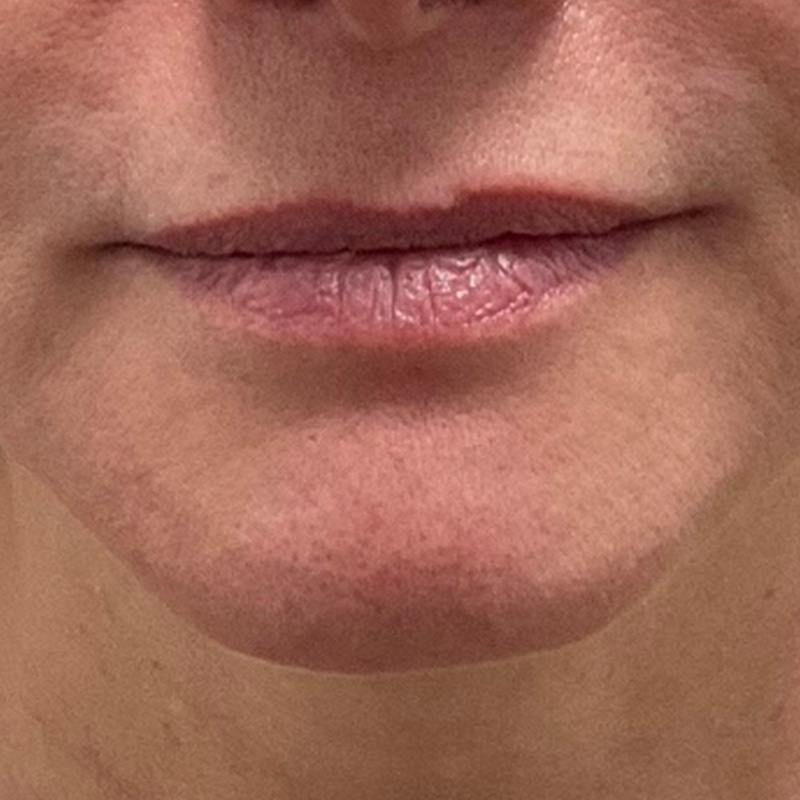 Lip Filler Before & After Gallery - Patient 175530404 - Image 1