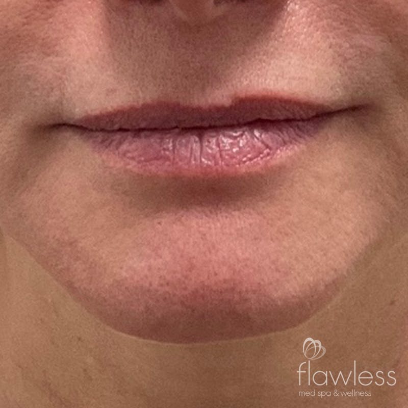 Lip Filler Before & After Gallery - Patient 175530404 - Image 1