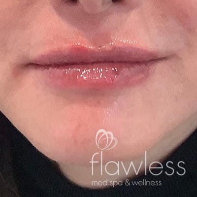 Lip Filler Before & After Gallery - Patient 175530404 - Image 2