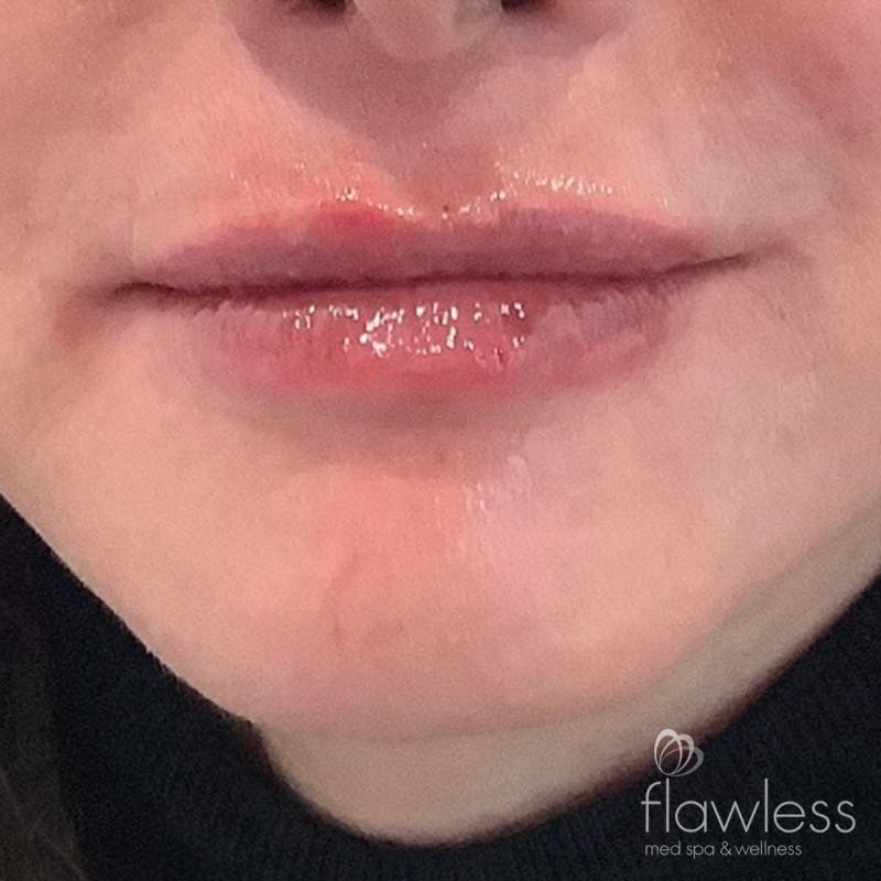 Lip Filler Before & After Gallery - Patient 175530404 - Image 2