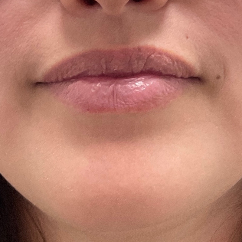Lip Filler Before & After Gallery - Patient 175530411 - Image 1