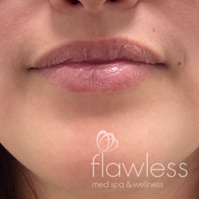 Lip Filler Before & After Gallery - Patient 175530411 - Image 1