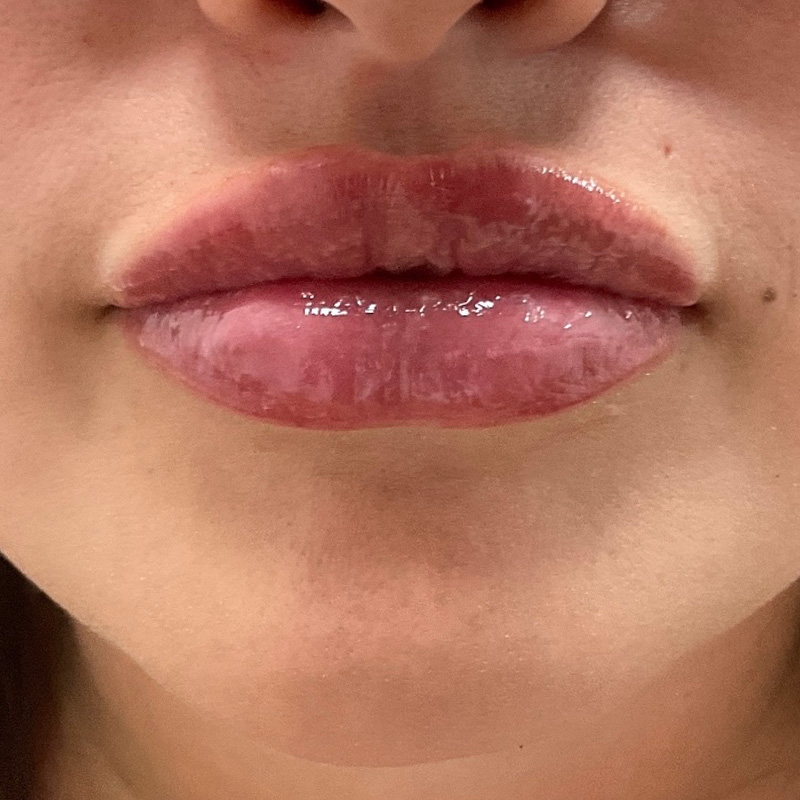 Lip Filler Before & After Gallery - Patient 175530411 - Image 2