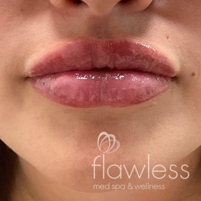 Lip Filler Before & After Gallery - Patient 175530411 - Image 2