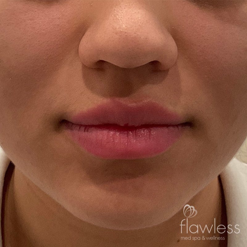 Lip Filler Before & After Gallery - Patient 175530403 - Image 1