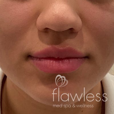 Lip Filler Before & After Gallery - Patient 175530403 - Image 1