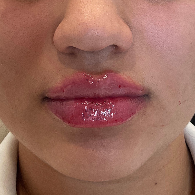 Lip Filler Before & After Gallery - Patient 175530403 - Image 2