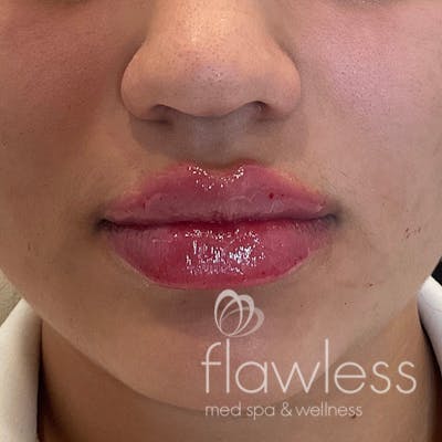 Lip Filler Before & After Gallery - Patient 175530403 - Image 2