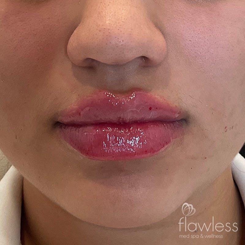 Lip Filler Before & After Gallery - Patient 175530403 - Image 2