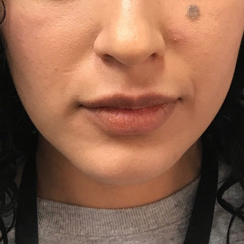 Lip Filler Before & After Gallery - Patient 175530397 - Image 1