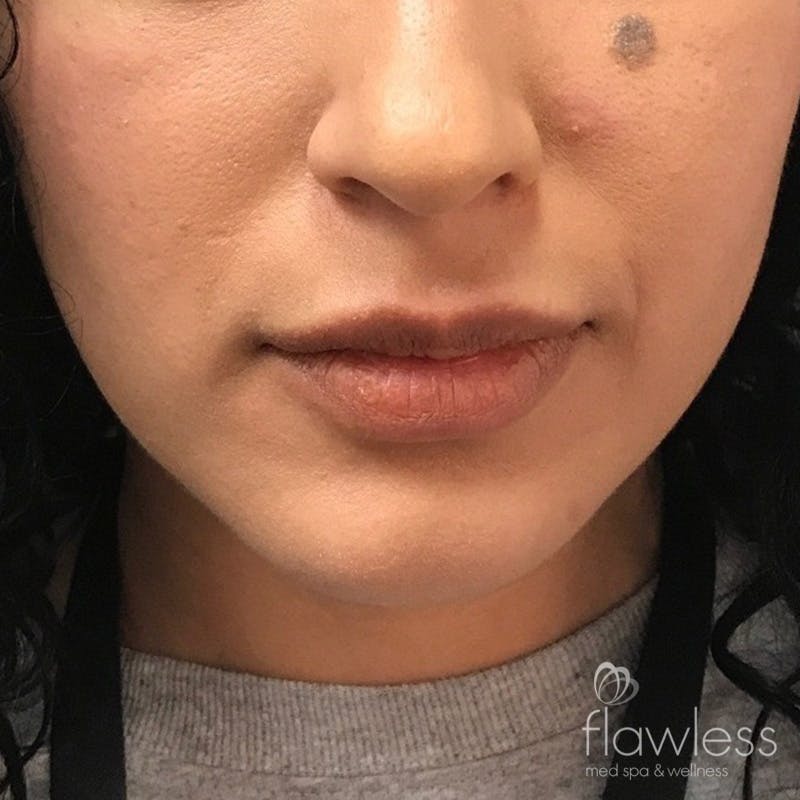 Lip Filler Before & After Gallery - Patient 175530397 - Image 1