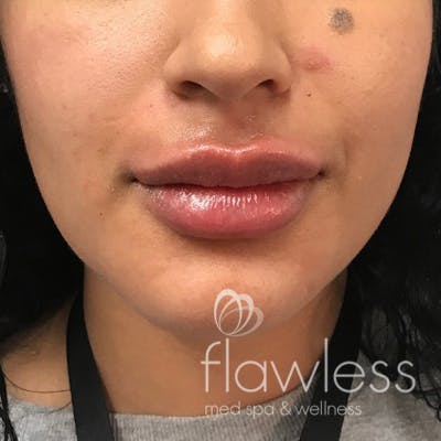 Lip Filler Before & After Gallery - Patient 175530397 - Image 2