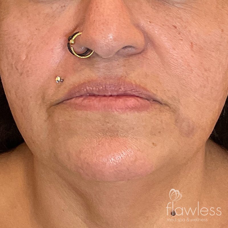 Lip Filler Before & After Gallery - Patient 175530402 - Image 1