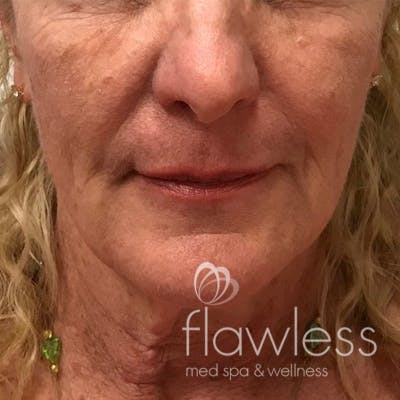 Cheek Filler Before & After Gallery - Patient 175530395 - Image 1