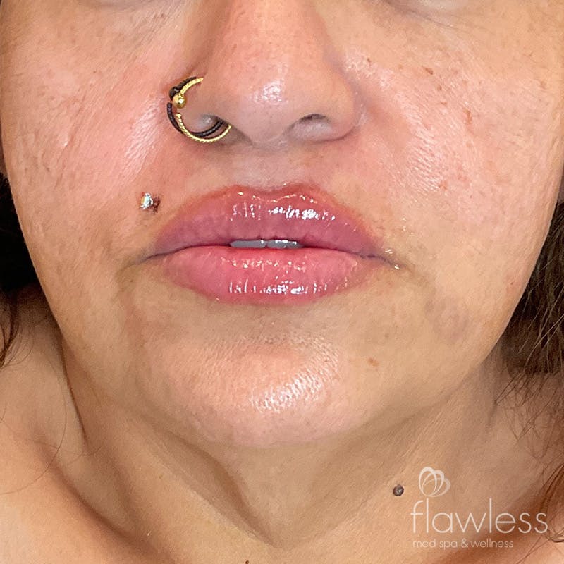 Lip Filler Before & After Gallery - Patient 175530402 - Image 2